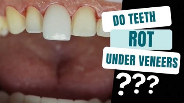 Do grills make your teeth rot?