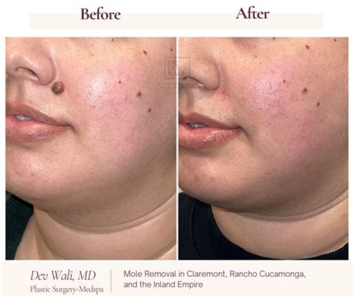 Does removing a mole stop melanoma?