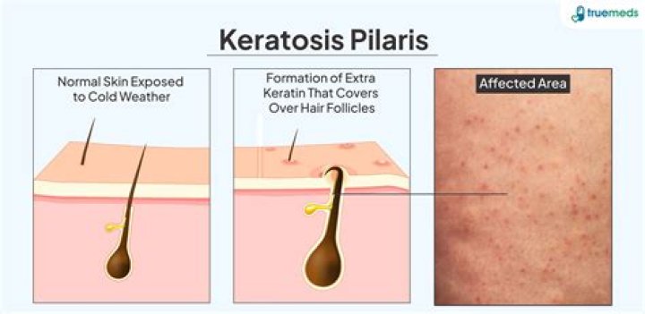 Famous Faces With Keratosis Pilaris