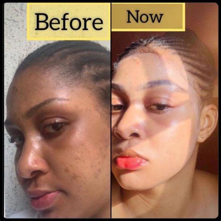 The Journey To Empowerment Before Skin Bleaching