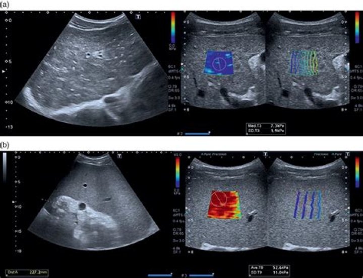 Unraveling Altered Parenchymal Echotexture: Unlocking Medical Mysteries