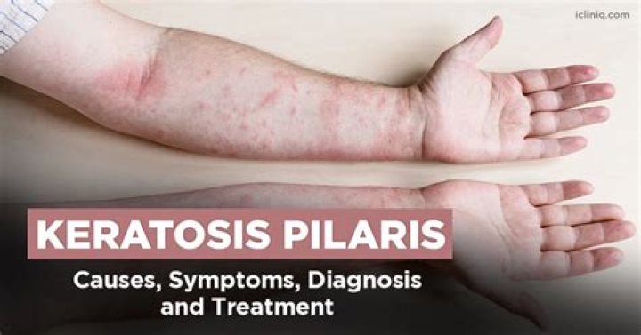 What Is Keratosis Pilaris (Chicken Skin) Causes, Signs & More GoodRx